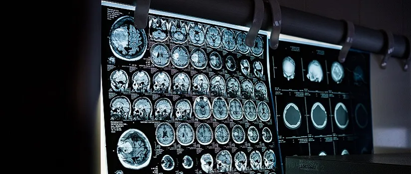 Best Neurologist Doctor in Rajim